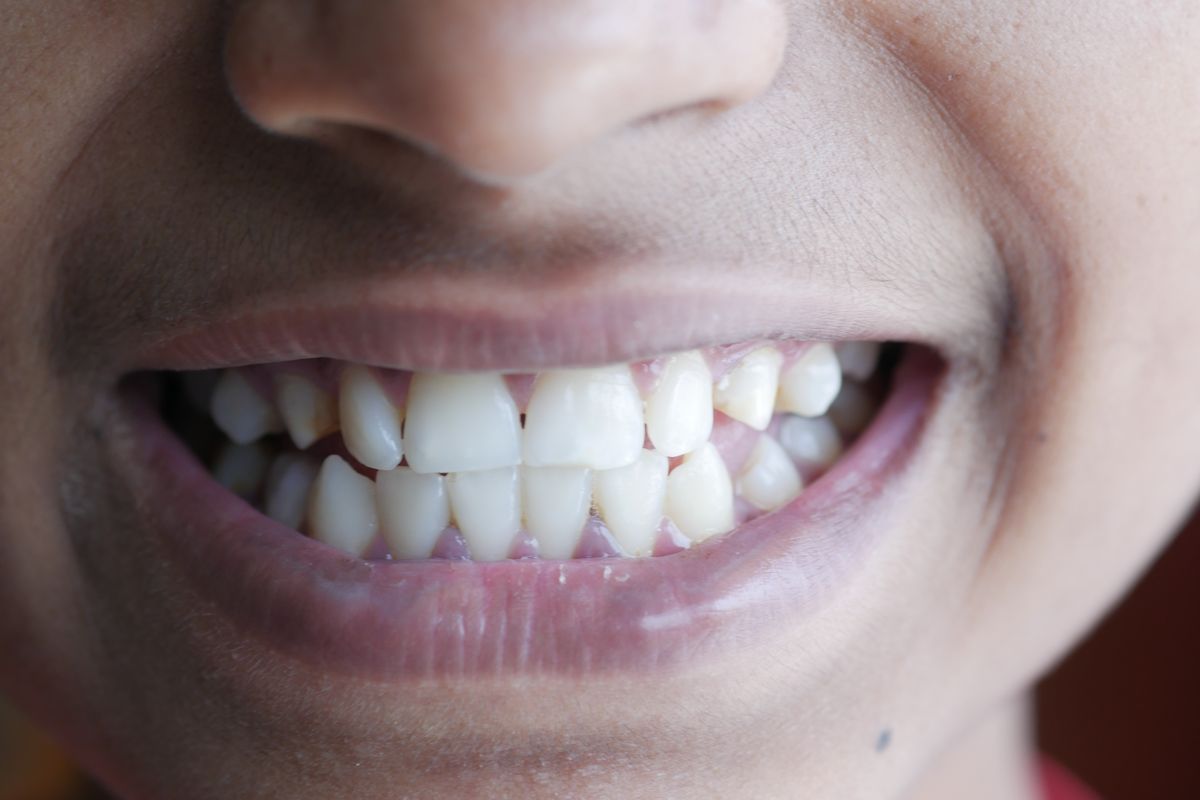 Invisalign Treatment