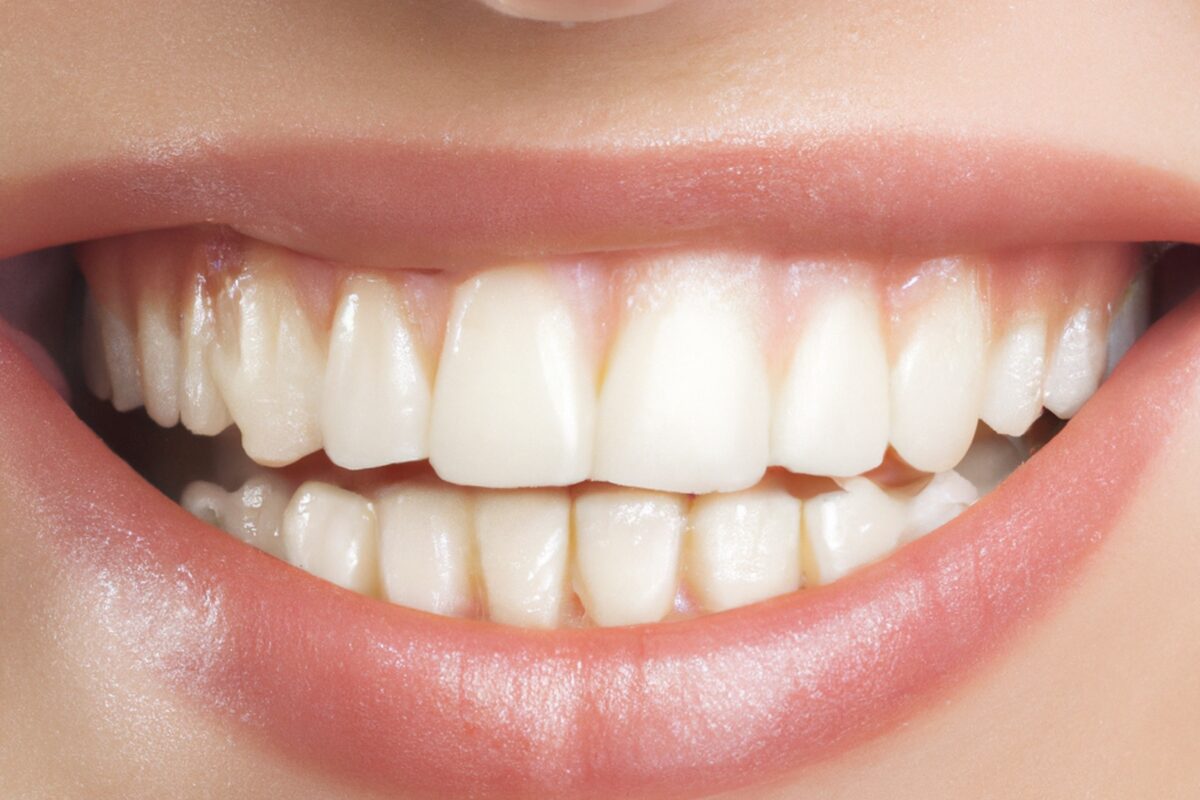Porcelain Veneers